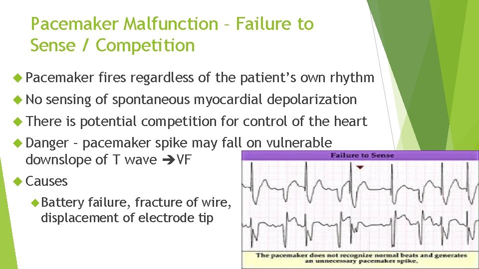 Pacemaker Malfunction – Failure to Sense / Competition Pacemaker No fires regardless of the