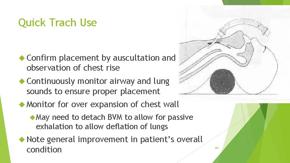 Quick Trach Use Confirm placement by auscultation and observation of chest rise Continuously monitor