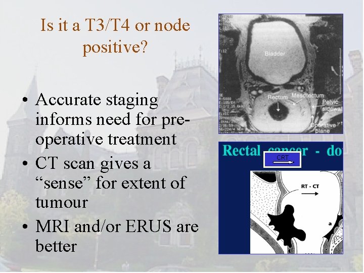 Is it a T 3/T 4 or node positive? • Accurate staging informs need