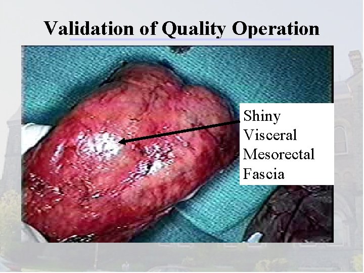 Validation of Quality Operation Shiny Visceral Mesorectal Fascia 