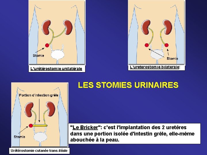 L'urétérostomie unilatérale L'urétérostomie bilatérale: LES STOMIES URINAIRES "Le Bricker": c'est l'implantation des 2 uretères