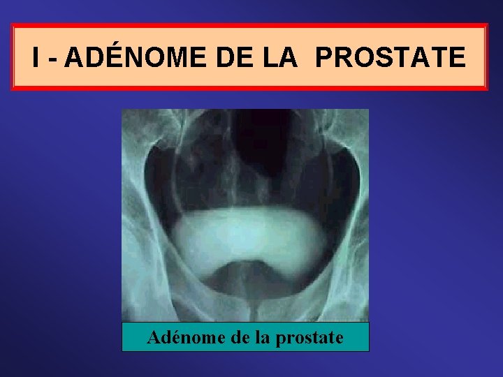 I - ADÉNOME DE LA PROSTATE Adénome de la prostate 