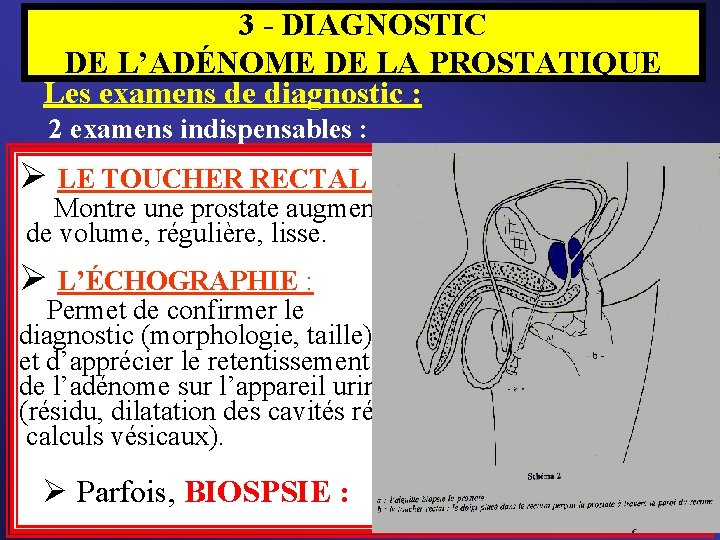 3 - DIAGNOSTIC DE L’ADÉNOME DE LA PROSTATIQUE Les examens de diagnostic : 2