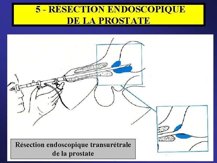  5 - RÉSECTION ENDOSCOPIQUE DE LA PROSTATE = Ablation partielle de la prostate