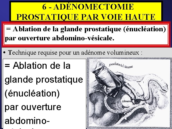  6 - ADÉNOMECTOMIE PROSTATIQUE PAR VOIE HAUTE = Ablation de la glande prostatique