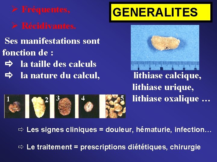  Fréquentes, GENERALITES Récidivantes. Ses manifestations sont fonction de : la taille des calculs