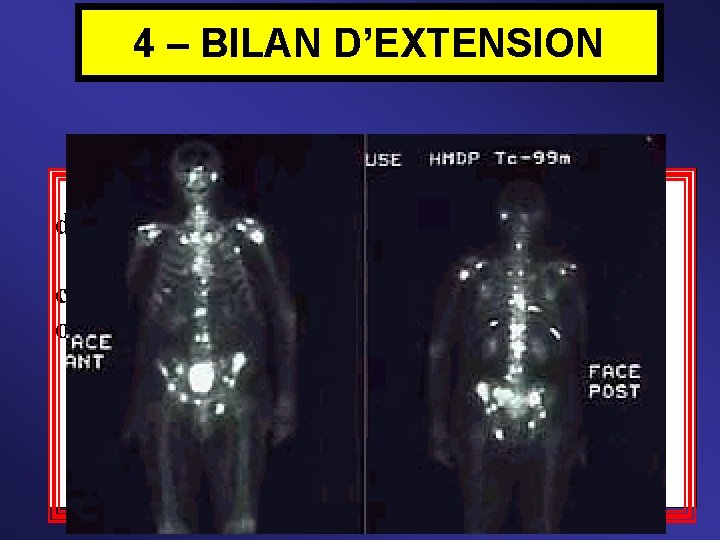 4 – BILAN D’EXTENSION Indispensable pour déterminer le degré d’évolution du cancer : Il