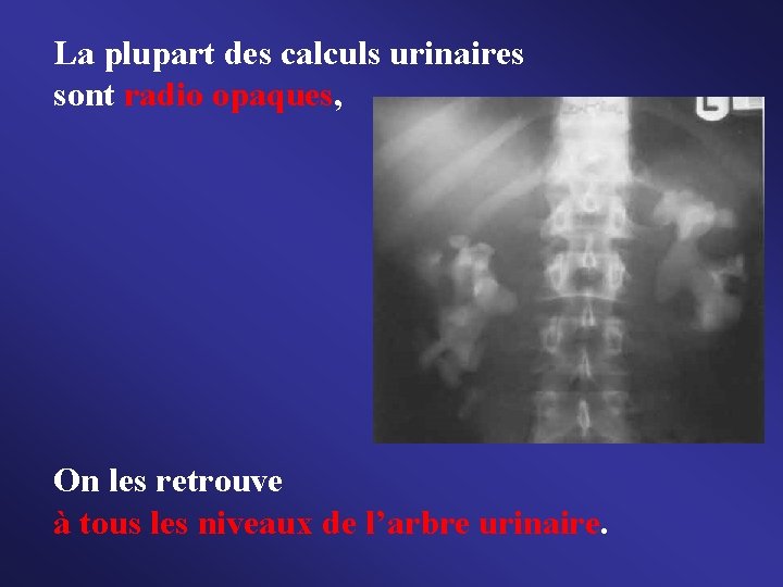 La plupart des calculs urinaires sont radio opaques, On les retrouve à tous les