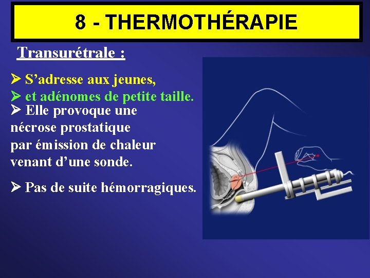 8 - THERMOTHÉRAPIE Transurétrale : S’adresse aux jeunes, et adénomes de petite taille. Elle