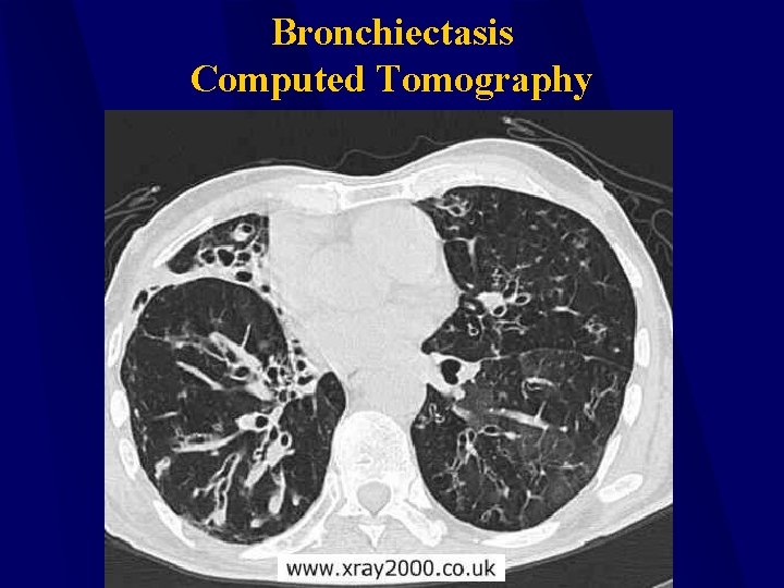 Bronchiectasis Computed Tomography 