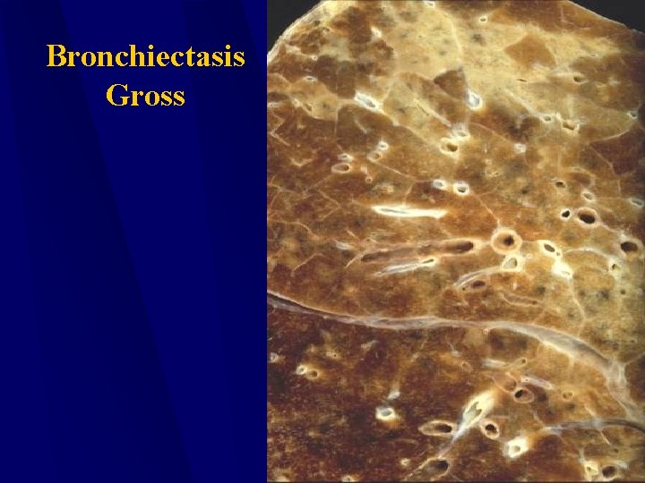 Bronchiectasis Gross 