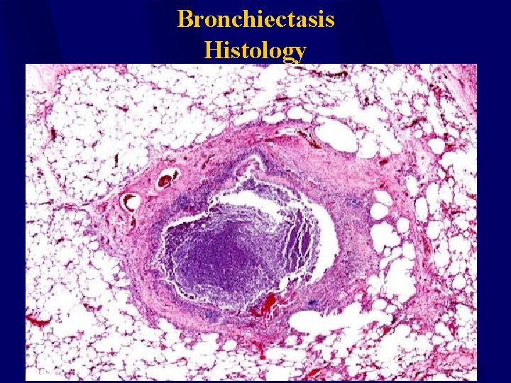 Bronchiectasis Histology 