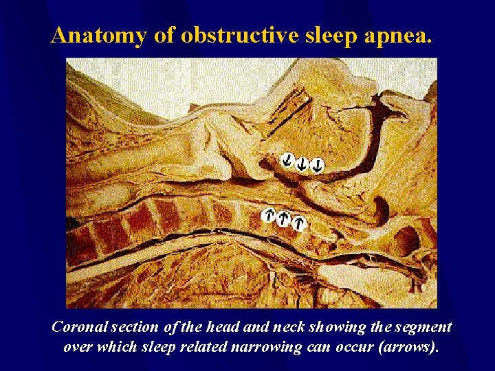 Anatomy of obstructive sleep apnea. Coronal section of the head and neck showing the