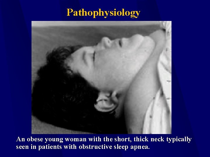 Pathophysiology An obese young woman with the short, thick neck typically seen in patients