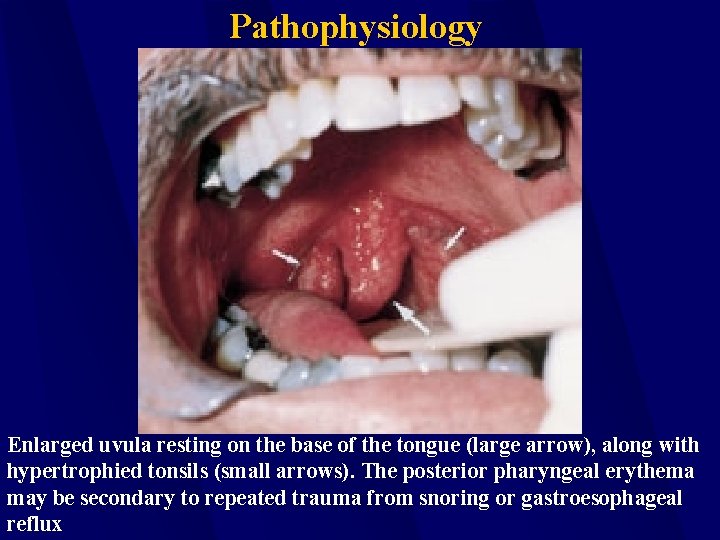 Pathophysiology Enlarged uvula resting on the base of the tongue (large arrow), along with