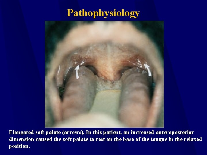 Pathophysiology Elongated soft palate (arrows). In this patient, an increased anteroposterior dimension caused the