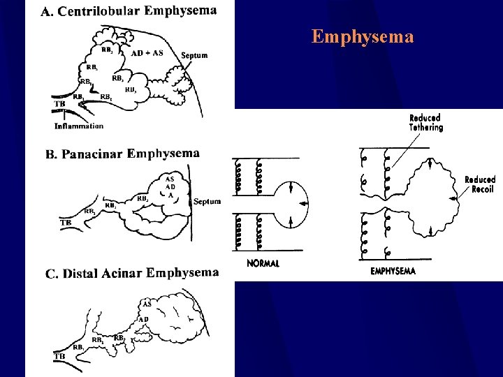 Emphysema 