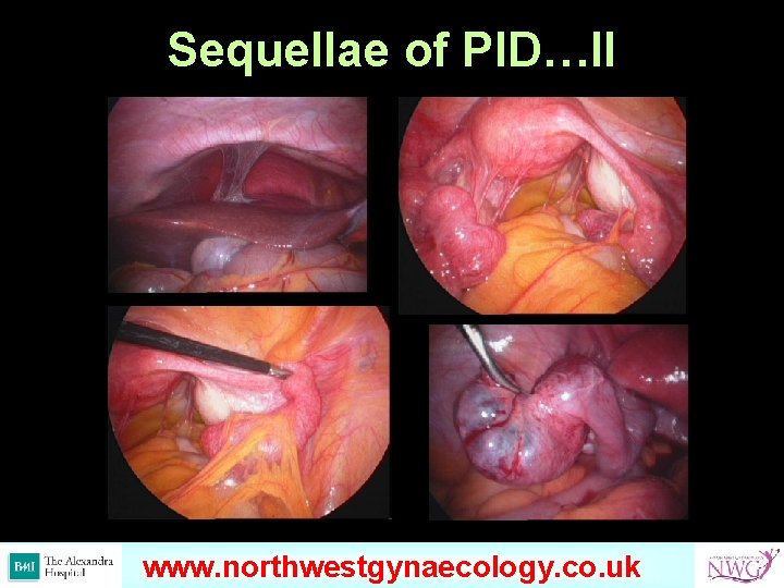 Sequellae of PID…II www. omondihealthcare. com www. northwestgynaecology. co. uk 