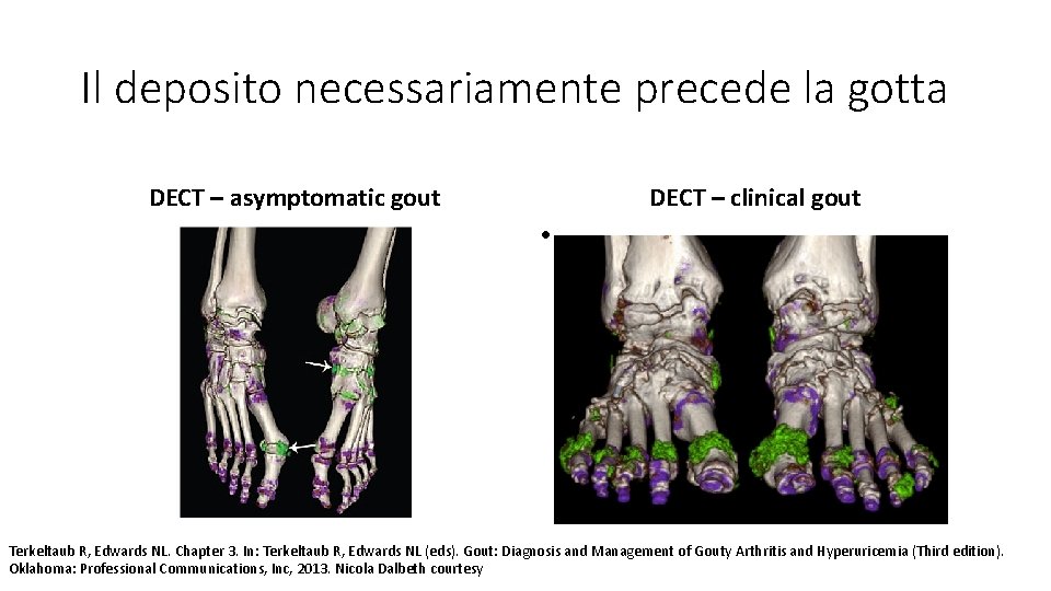 Il deposito necessariamente precede la gotta DECT – asymptomatic gout DECT – clinical gout