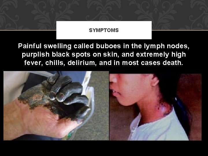 SYMPTOMS Painful swelling called buboes in the lymph nodes, purplish black spots on skin,