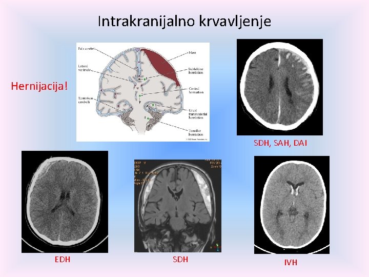 Intrakranijalno krvavljenje Hernijacija! SDH, SAH, DAI EDH SDH IVH 