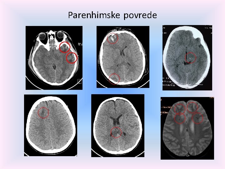 Parenhimske povrede 