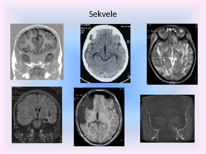 Sekvele 