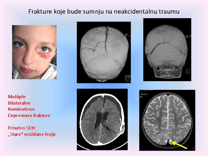 Frakture koje bude sumnju na neakcidentalnu traumu Multiple Bilateralne Kominutivne Depresione frakture Prisutvo SDH
