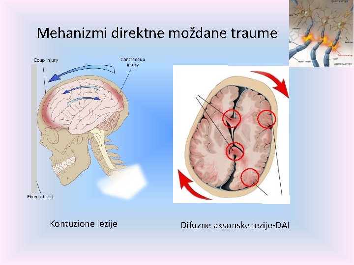 Mehanizmi direktne moždane traume Kontuzione lezije Difuzne aksonske lezije-DAI 