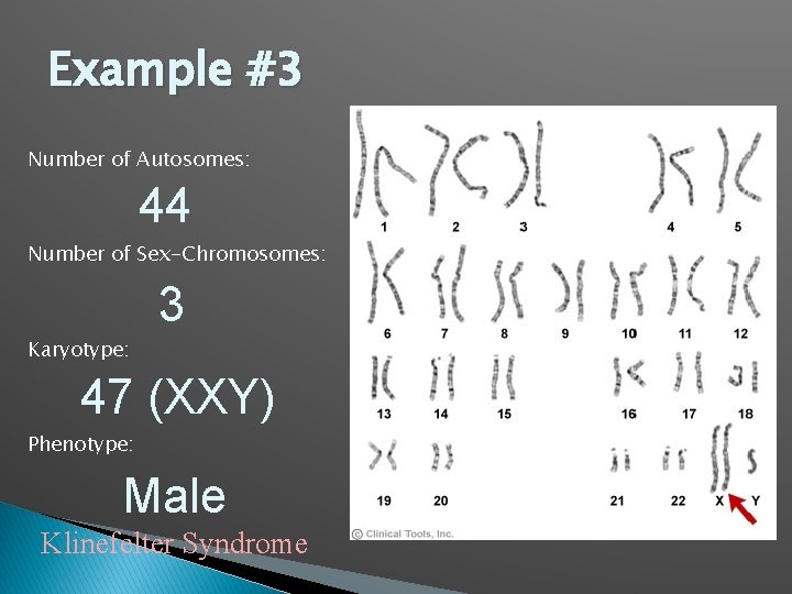 Example #3 Number of Autosomes: 44 Number of Sex-Chromosomes: 3 Karyotype: 47 (XXY) Phenotype: