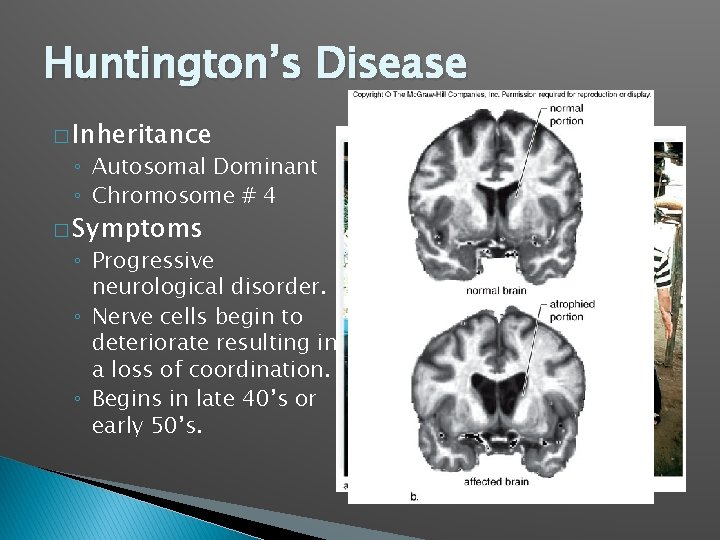 Huntington’s Disease � Inheritance ◦ Autosomal Dominant ◦ Chromosome # 4 � Symptoms ◦