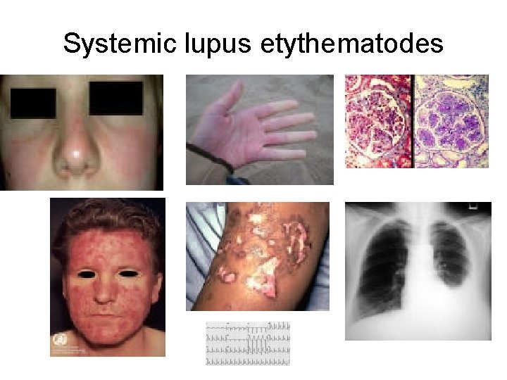 Systemic lupus etythematodes 