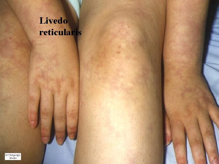 Livedo reticularis 