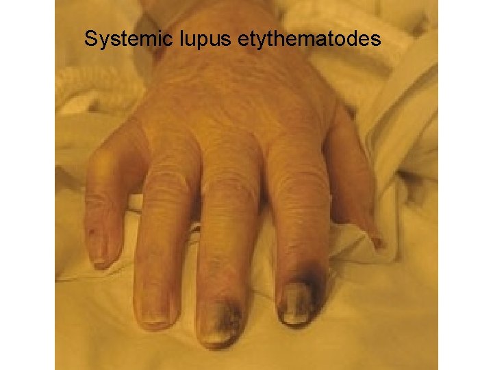 Systemic lupus etythematodes 