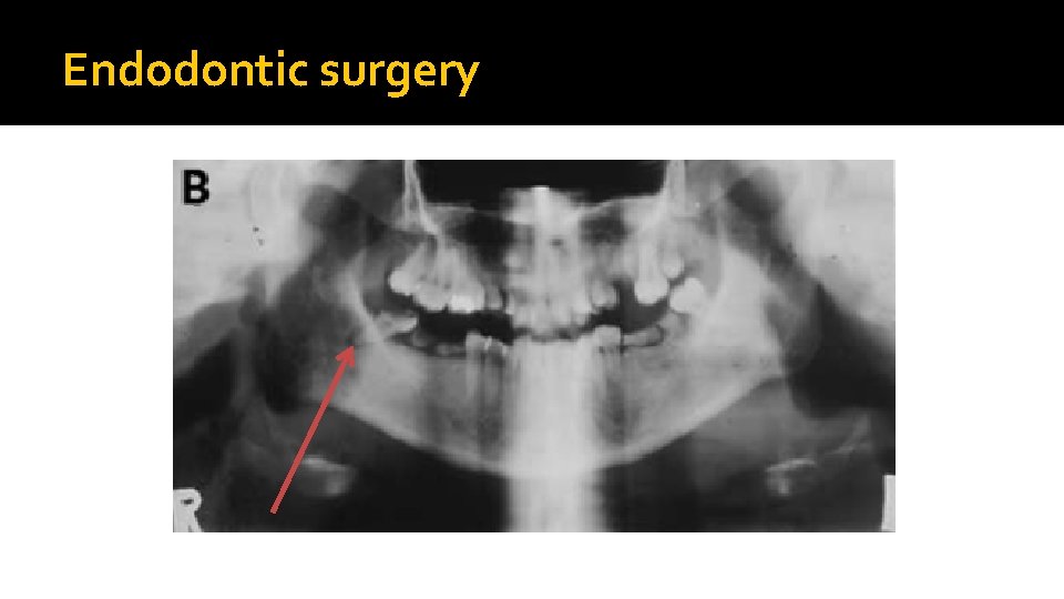 Endodontic surgery 