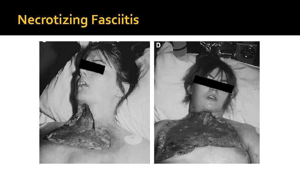 Necrotizing Fasciitis 