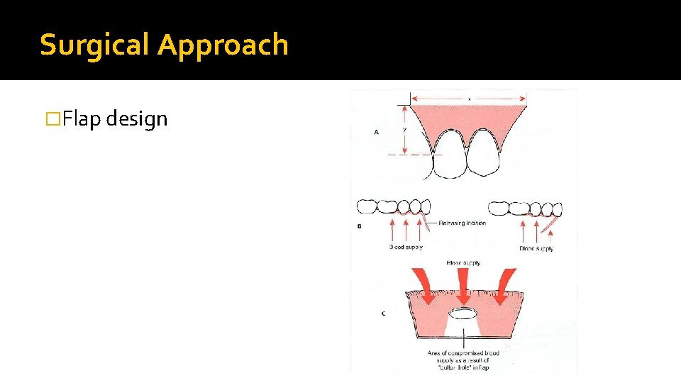 Surgical Approach �Flap design 