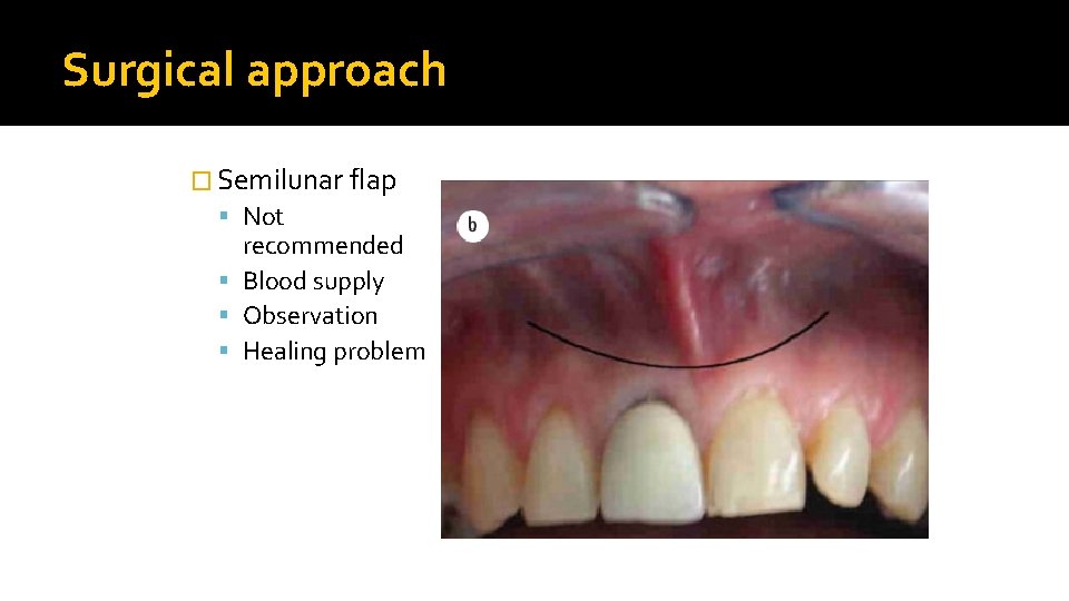 Surgical approach � Semilunar flap Not recommended Blood supply Observation Healing problem 