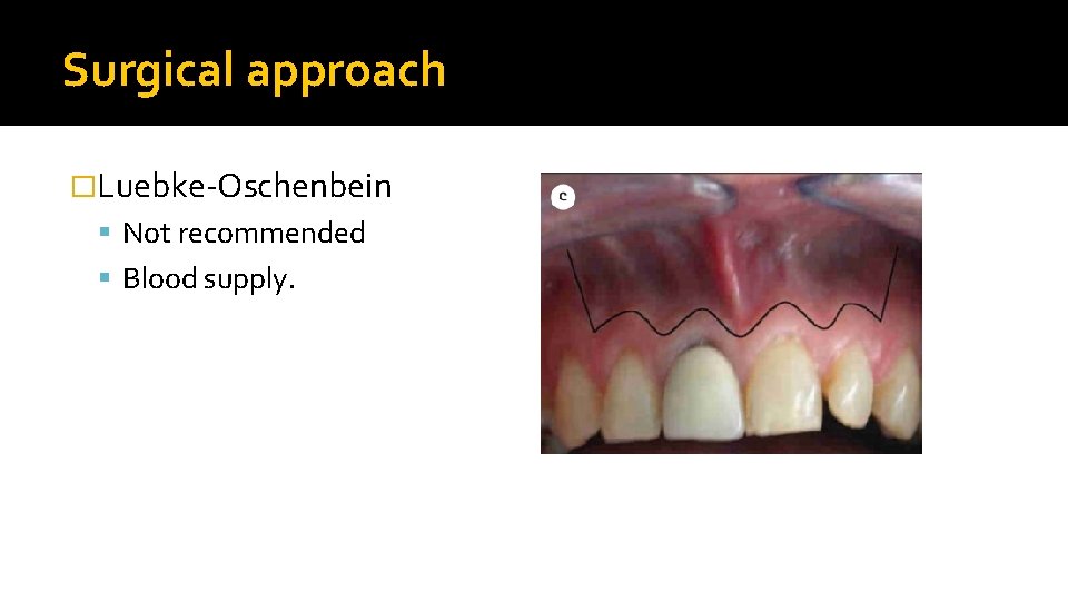 Surgical approach �Luebke-Oschenbein Not recommended Blood supply. 