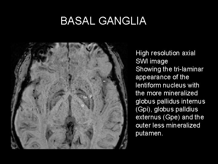 BASAL GANGLIA Ge Gi P High resolution axial SWI image Showing the tri-laminar appearance