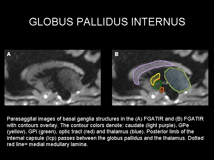 GLOBUS PALLIDUS INTERNUS A B ICp Parasaggital images of basal ganglia structures in the