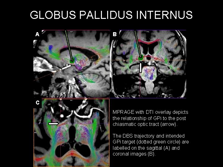 GLOBUS PALLIDUS INTERNUS A B C MPRAGE with DTI overlay depicts the relationship of