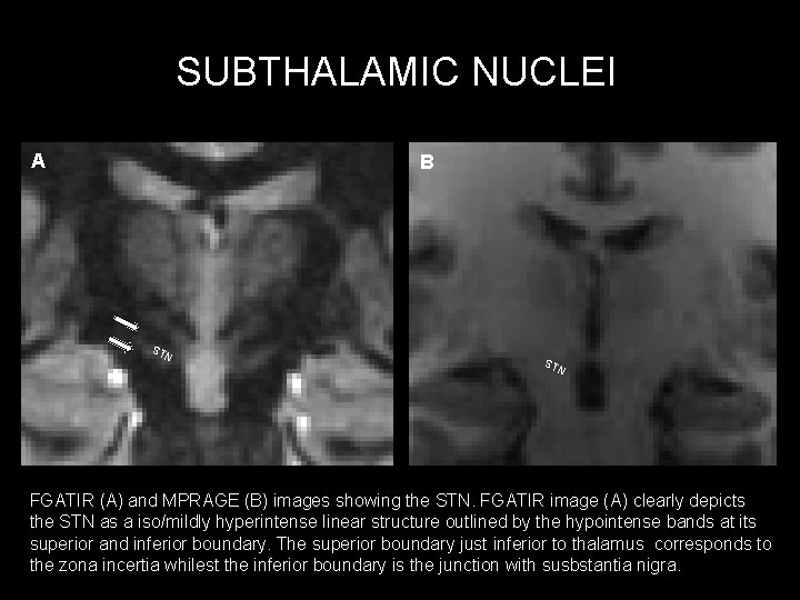 SUBTHALAMIC NUCLEI A B ST N FGATIR (A) and MPRAGE (B) images showing the