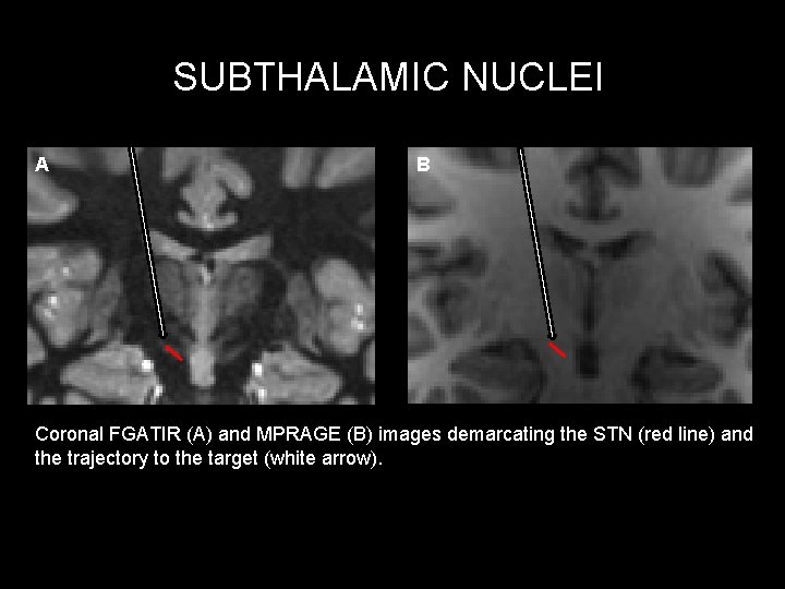 SUBTHALAMIC NUCLEI A B Coronal FGATIR (A) and MPRAGE (B) images demarcating the STN