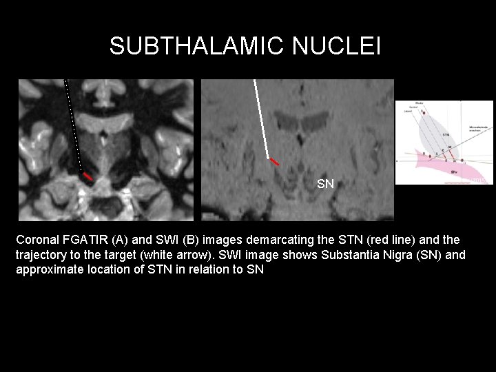 SUBTHALAMIC NUCLEI SN Coronal FGATIR (A) and SWI (B) images demarcating the STN (red