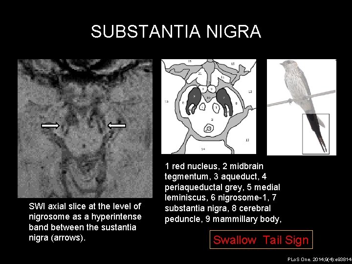 SUBSTANTIA NIGRA SWI axial slice at the level of nigrosome as a hyperintense band