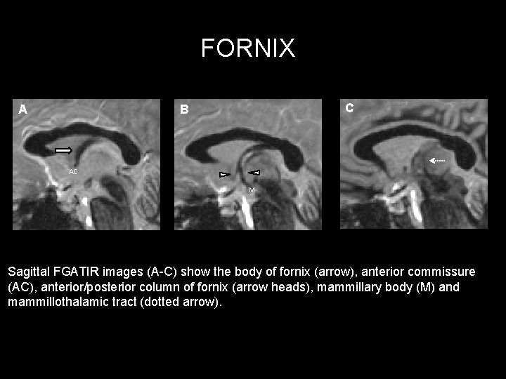 FORNIX A C B AC M Sagittal FGATIR images (A-C) show the body of