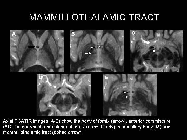 MAMMILLOTHALAMIC TRACT A C B AC D E M Axial FGATIR images (A-E) show