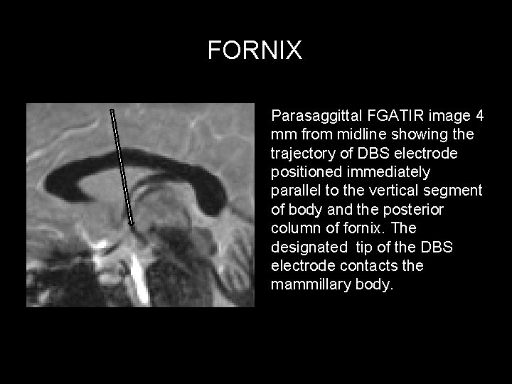 FORNIX Parasaggittal FGATIR image 4 mm from midline showing the trajectory of DBS electrode