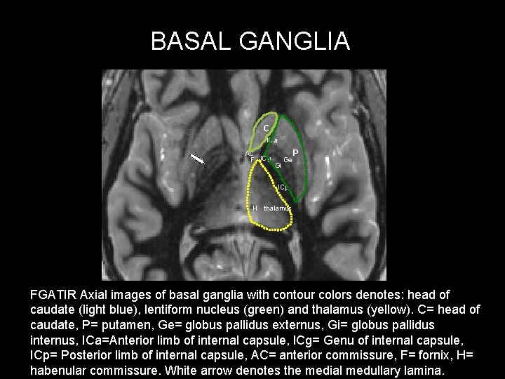 BASAL GANGLIA C ICa AC F ICg Gi Ge P ICp H thalamus FGATIR